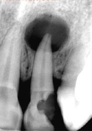 根尖病--根尖周肉芽肿(periapcal granuloma)