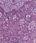 人乳头瘤病毒与皮肤肿瘤(图片:临床 病理)