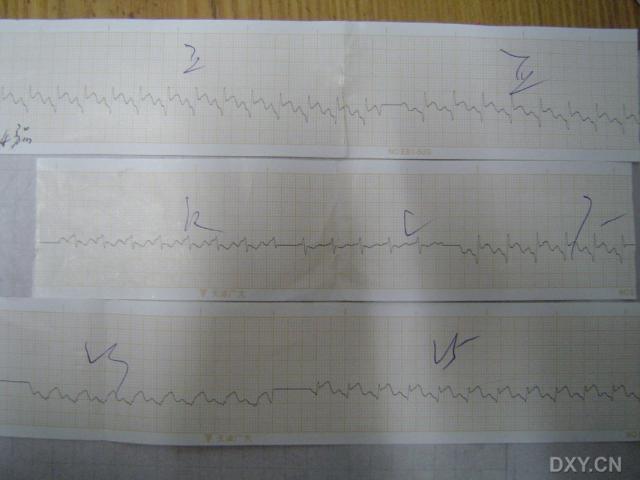 女生心电图酷似急性心梗