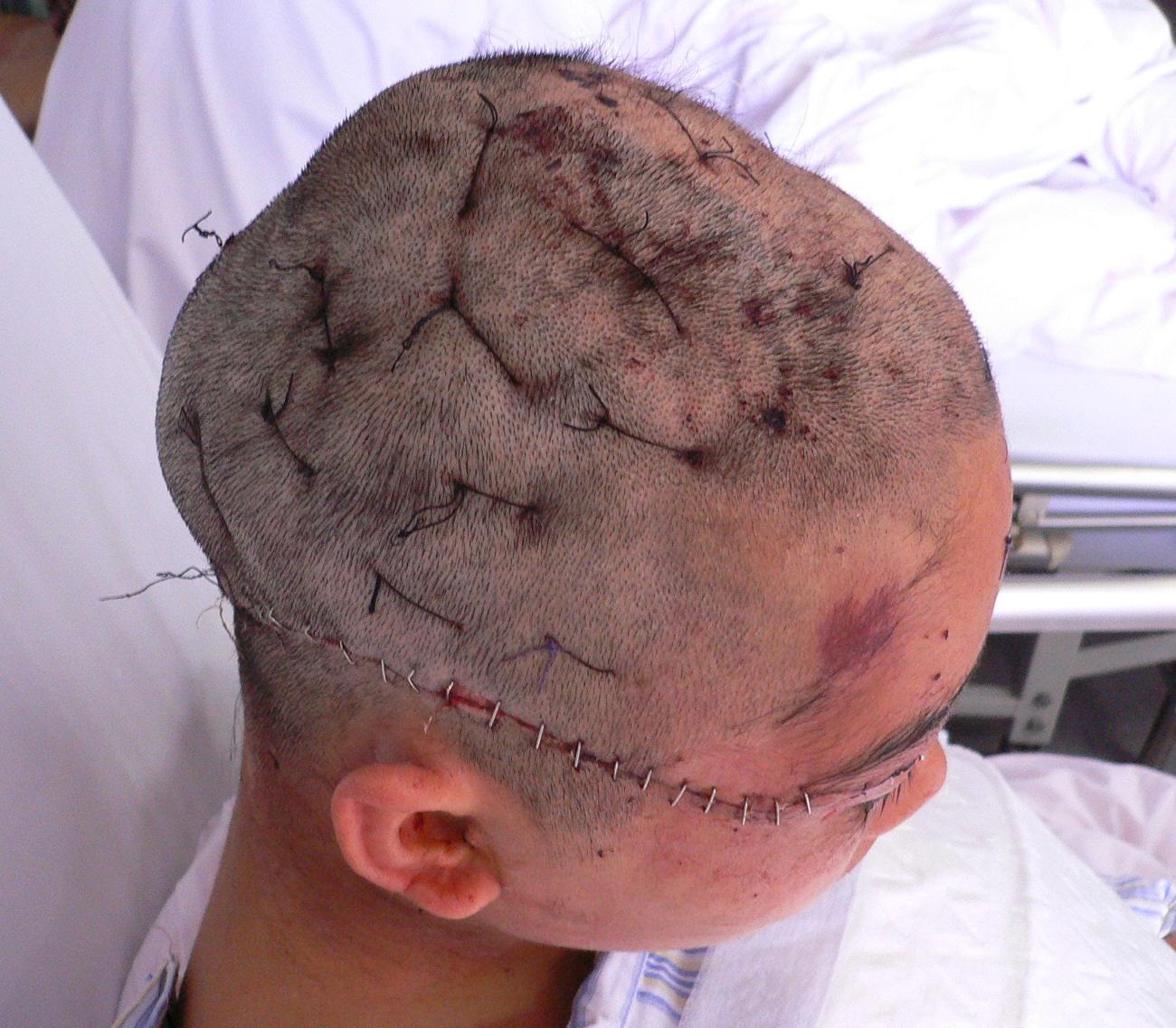 时不慎头发被机器绞卷致头皮大面积剥脱伤,入院后急诊清创原位回植,术