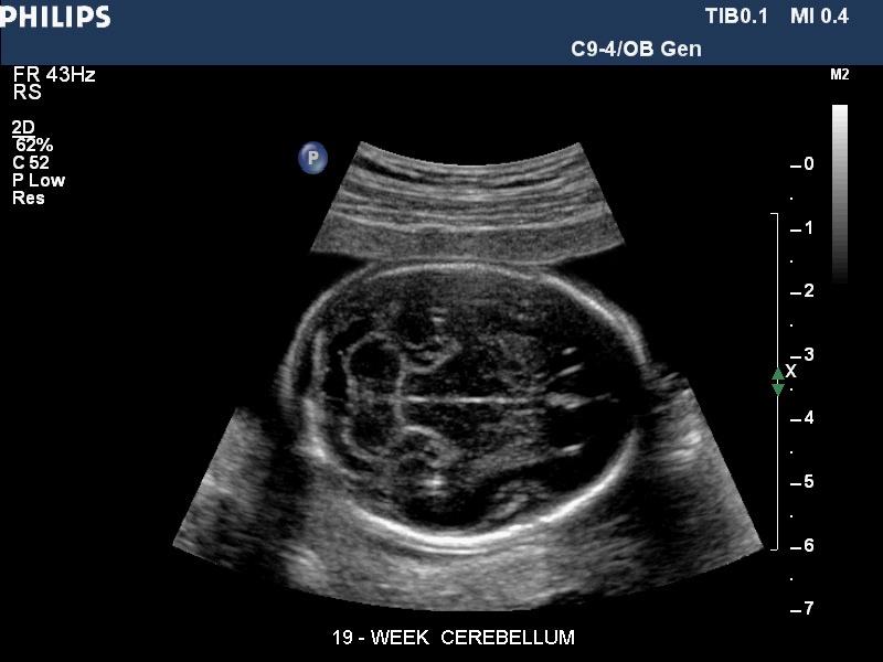 【转贴【分享】胎儿与新生儿头部超声图片