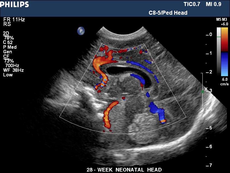 【转贴【分享】胎儿与新生儿头部超声图片