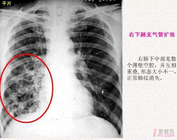 【分享】胸部影像学 [ 一 ] 支气管扩张