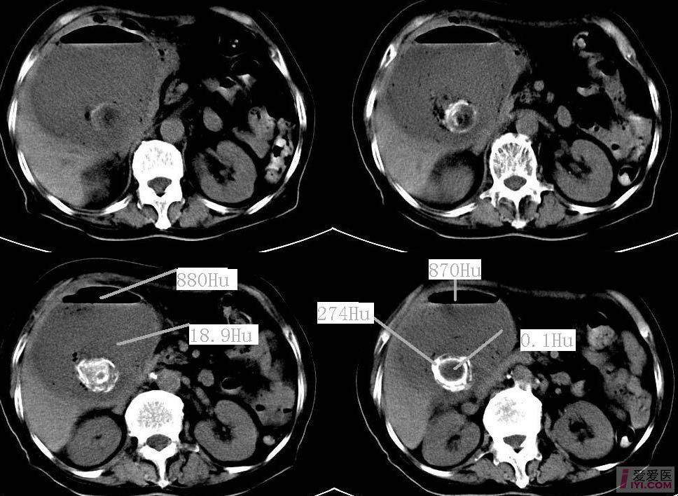 胆囊ct病例