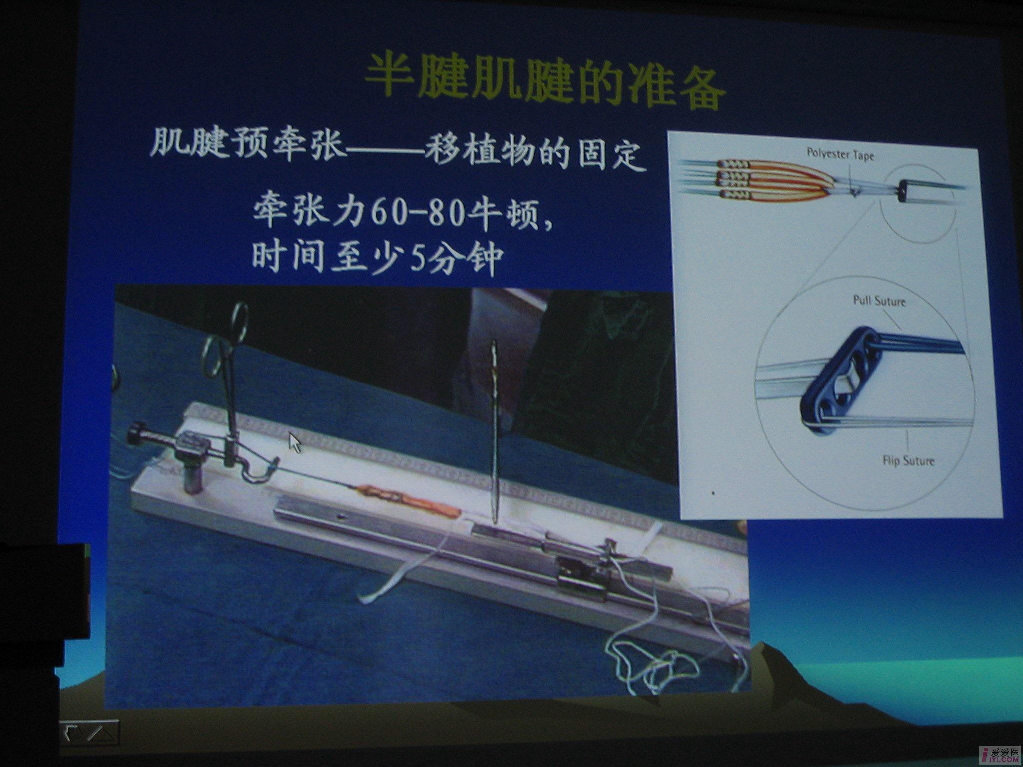 【贴图】半腱肌 缝线钢板重建前交叉韧带