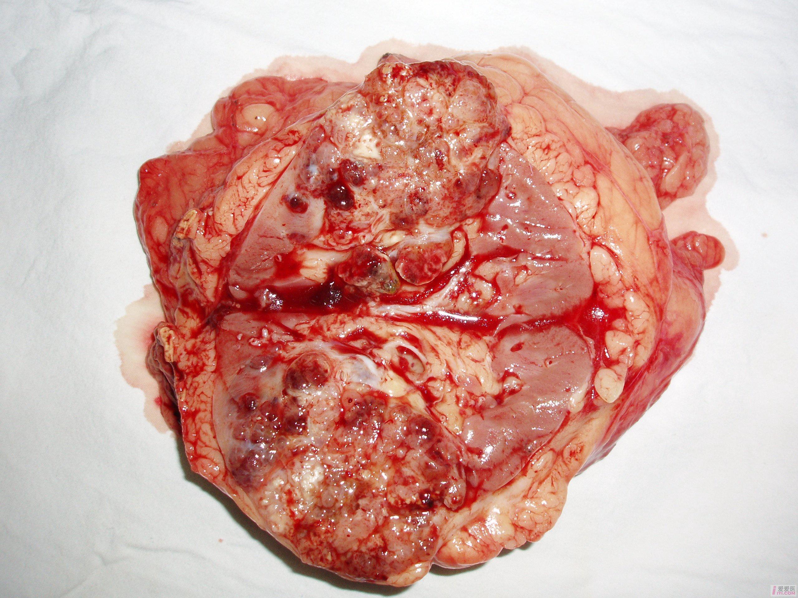 【贴图 肾癌无瘤切除术的标本以及相关ct片