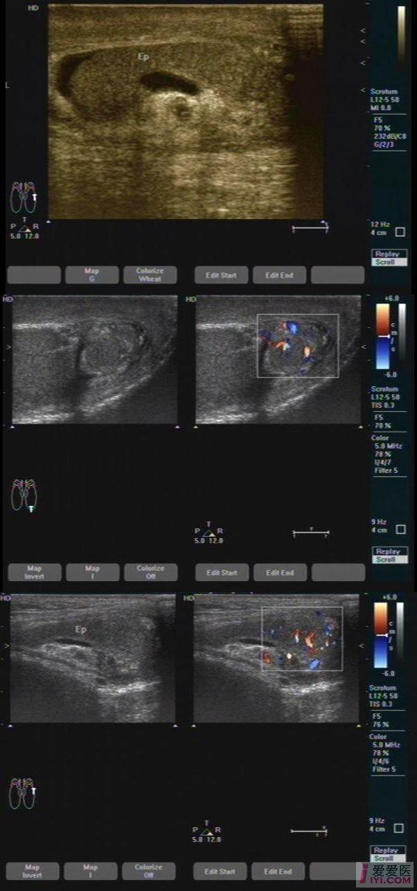 【贴图】难得一见的附睾全貌,虽然. - 超声医学版