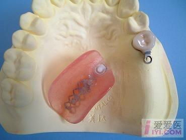 【推荐】新技术 太极扣局部义齿附着体