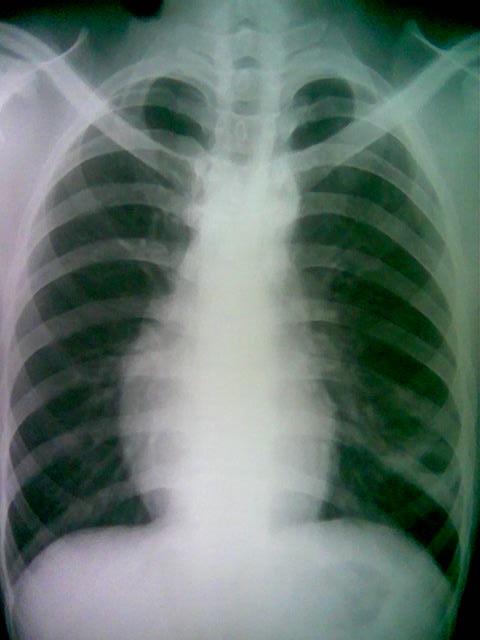 肺脓肿/支气管囊肿?