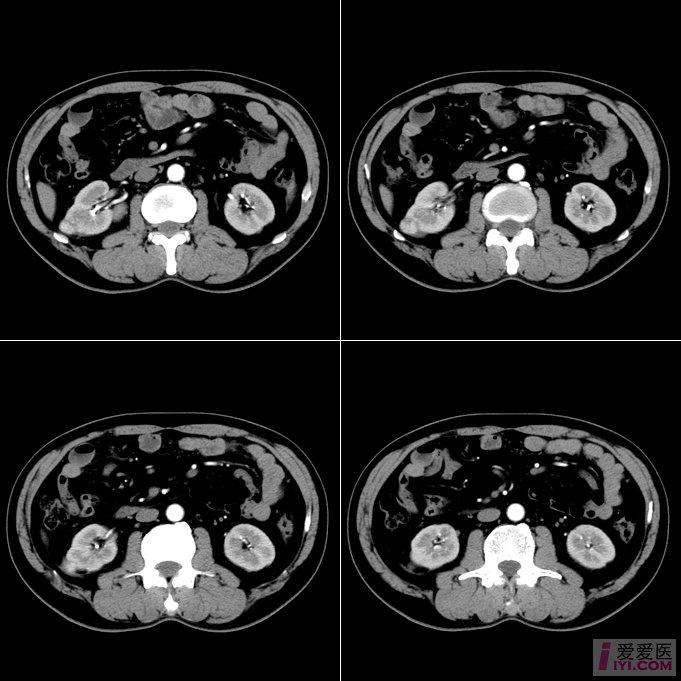 【读片】右肾病变ct(有病理结果)