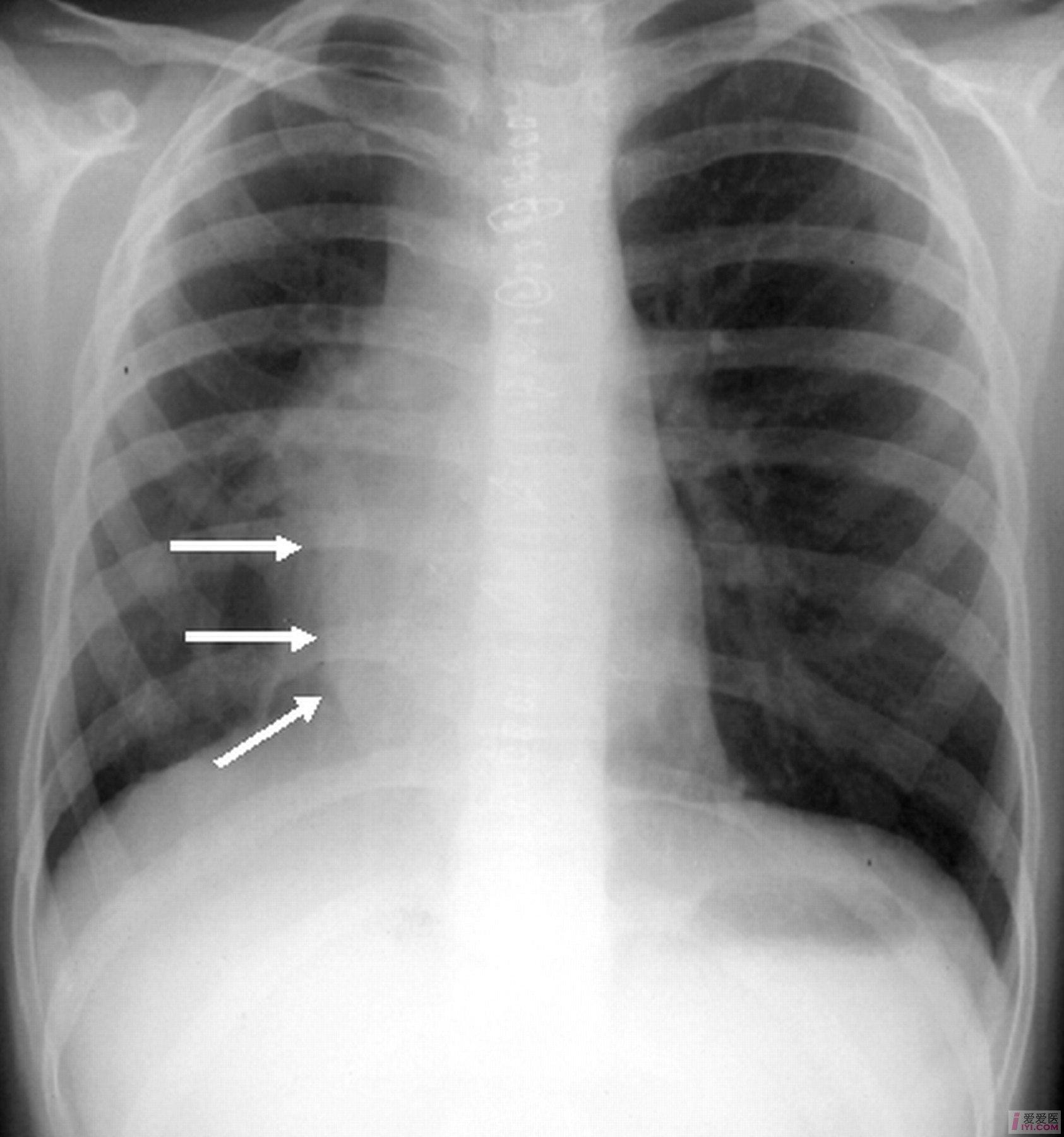 右侧胸廓明显塌陷,肋间隙狭窄,右肺呈大片密度增高改变;  2.