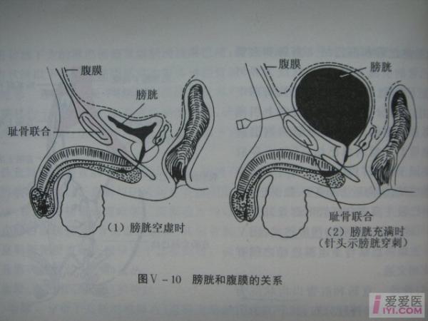 【讨论】膀胱造瘘