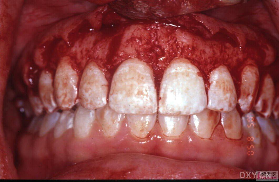 【转贴】牙龈修整图片