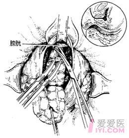 切除术(miles)    经腹,会阴直肠肛管根治切除术是治疗直肠肛管癌较常