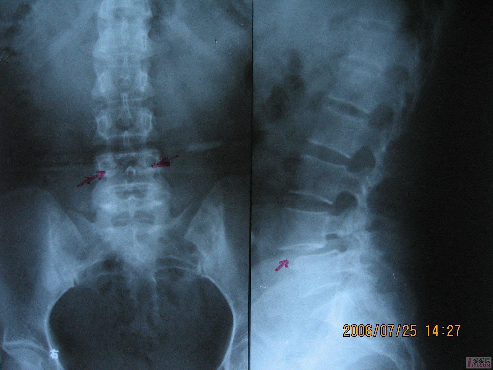 今天下午拍的腰椎片子很典型的病例