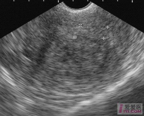 超声所见:子宫增大,内膜厚12mm,子宫前壁肌层见68*56mm低回声区