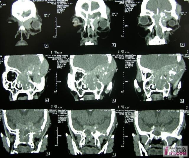 【分享】鼻窦肿瘤ct图片汇总
