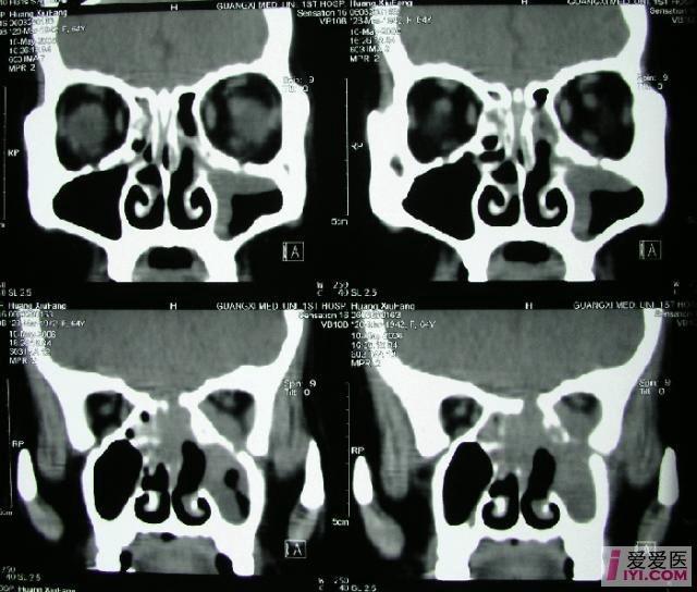 【分享】鼻窦肿瘤ct图片汇总