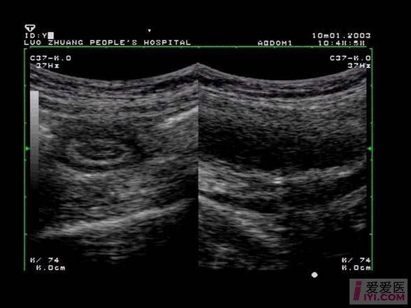 续转【贴图】急性阑尾炎的声像图表现 - 超声医学讨论