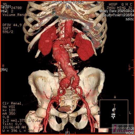 【原创】漂亮的腹主动脉瘤图片