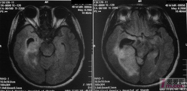 枕叶病变 - 医学影像学讨论版 - 爱爱医医学论坛-爱爱医医学网