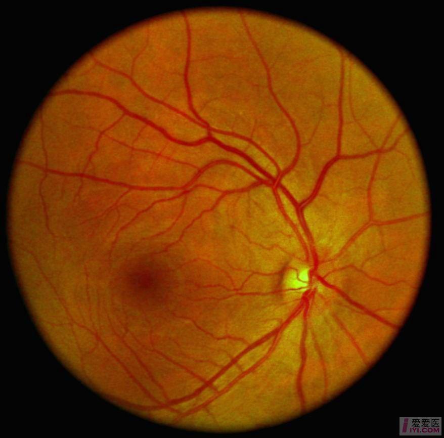 征集高清晰典型眼底病图片