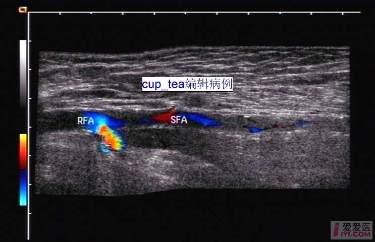 超声考虑为陈旧性血栓部分再通的病例    上传的图象中对右下肢股动脉