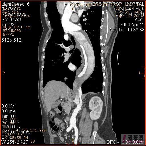 主动脉夹层动脉瘤ct