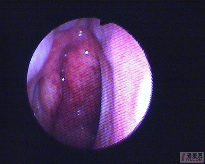 【讨论】鼻咽部检查一例