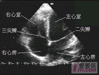 腔心切面声像图   7,心尖四腔心切面声像图   8,心尖五腔心切面声像图