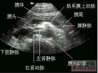 切面(图像说明:ao腹主动脉  pa胰腺   spv脾静脉)   胰腺超声检查测量