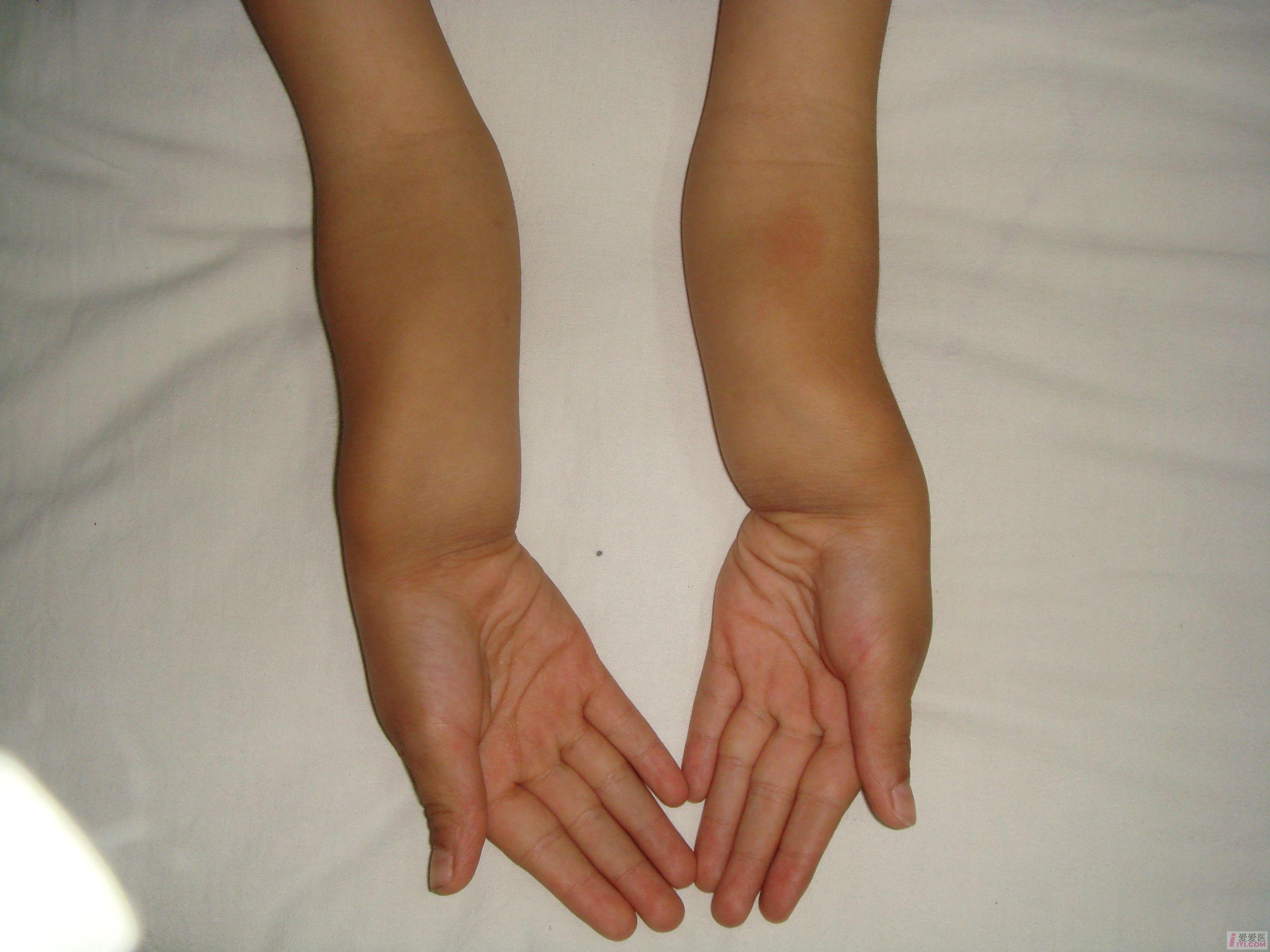 【讨论】马德隆畸形