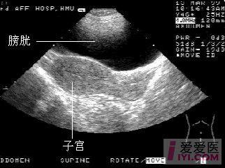 经阴道扫查示意图   子宫附件经直肠扫查示意图   子宫纵切面声像图