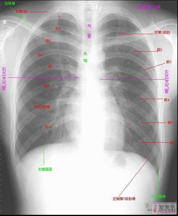 胸廓对称,气管居中,纵隔影不宽,肺门影不大,双肺纹理清晰(增强)