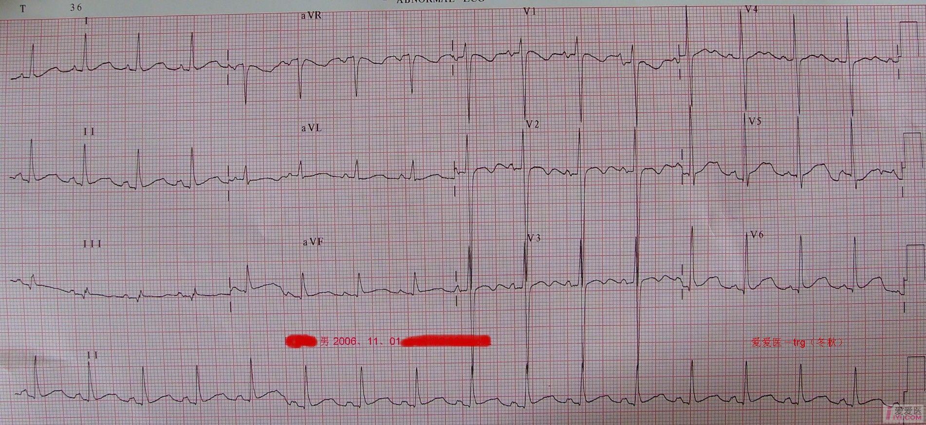 【原创】心电图欣赏 之二(2006-11-26)