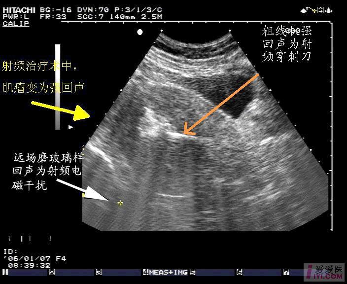 【原创】射频治疗子宫肌瘤超声图像