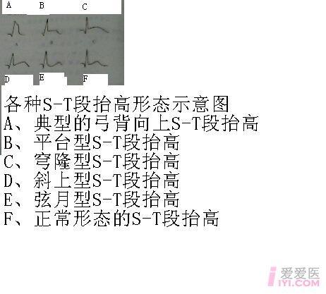 弓背向下可正常          过速急性心包炎(一种是弓背向下抬高