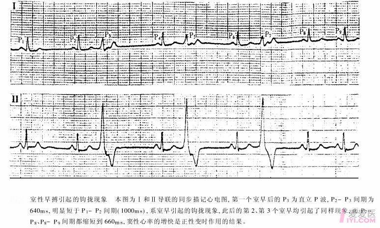 17:22:25   钩拢现象           钩拢现象是一种特殊的心电图干扰现象