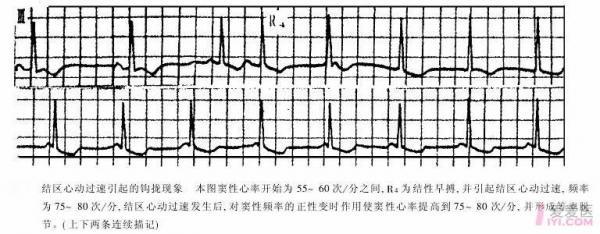 心电图现象之三 钩拢现象