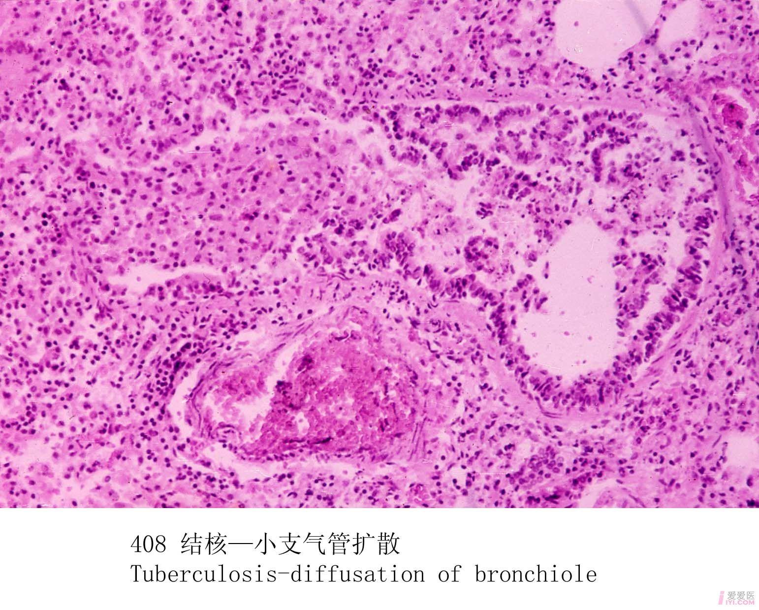 【贴图】结核的病理图片,病理标本