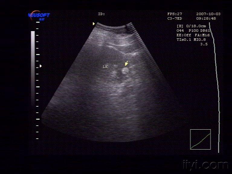 左肾错构瘤 - 超声医学讨论版 - 爱爱医医学论坛 - 医