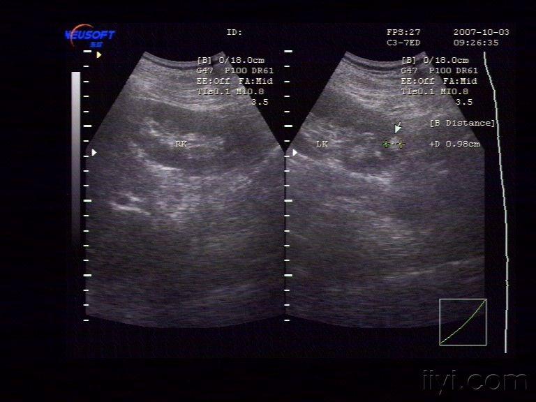 左肾错构瘤 - 超声医学讨论版 - 爱爱医医学论坛 - 医