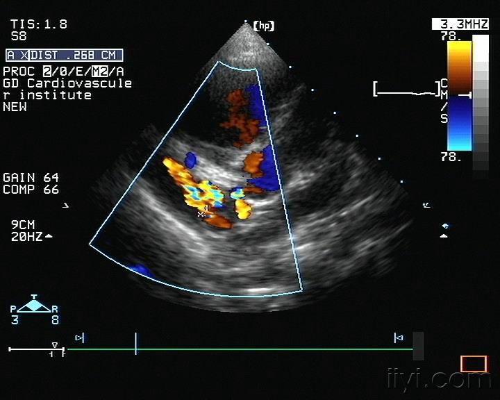 右冠状动脉-右房瘘 超声医学讨论版 爱爱医医学论坛 爱爱医医学