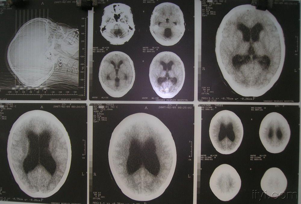 慢性脑积水及小脑扁桃体下疝的诊治