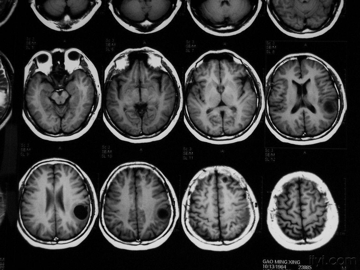 影像学每周一病之2-脑囊虫病