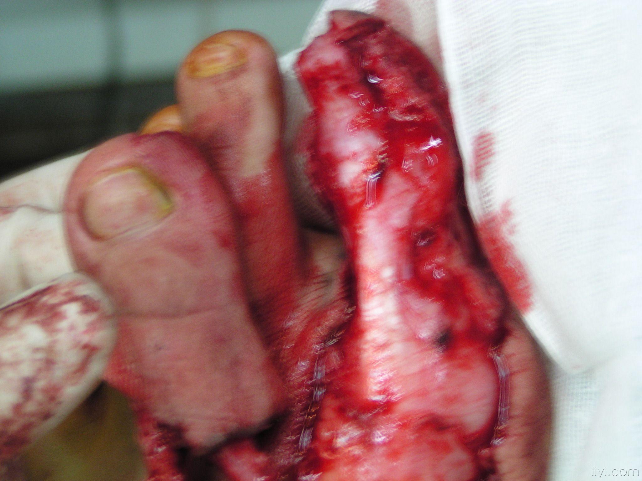 大脚趾再造拇指改良 - 骨科与显微外科专业讨论版