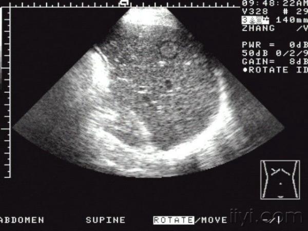 肝脏疾病声像图表现 超声医学讨论版 爱爱医医学论坛 爱爱医