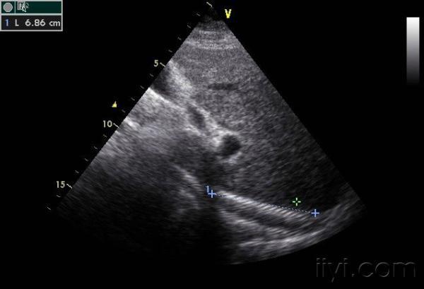 肝脏疾病声像图表现