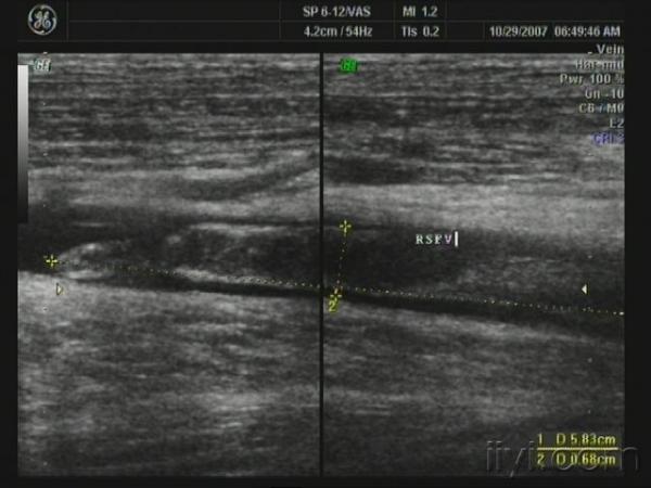 下肢深静脉血栓形成 - 超声医学讨论版 - 爱爱医医学论坛 - 爱爱医