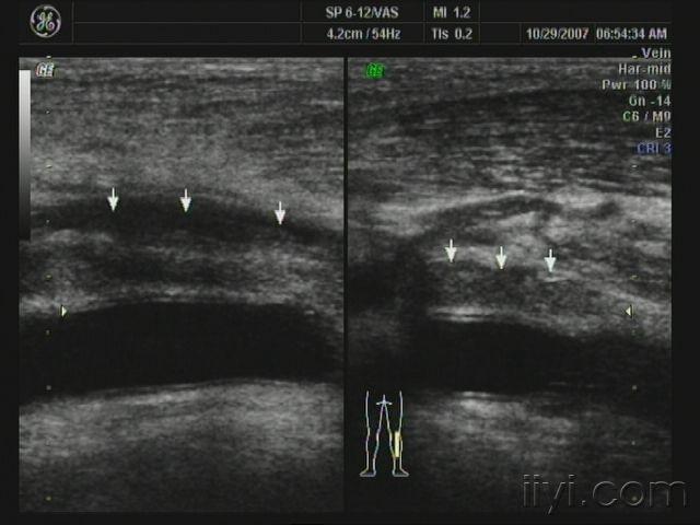 下肢深静脉血栓形成 - 超声医学讨论版 - 爱爱医医学论坛 - 爱爱医